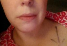 I s-a spus că are cancer, a intrat imediat în sala de operație, dar când i-au scos tumora, medicii au rămas fără cuvinte: „Doamnă, ăsta nu e cancer, nici nu știți ce v-ați făcut singură!” Ce au scos din ea cancer piele