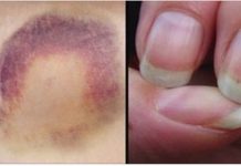Simptome ale cancerului pe care femeile obișnuiesc să le ignore cel mai des semne cancer