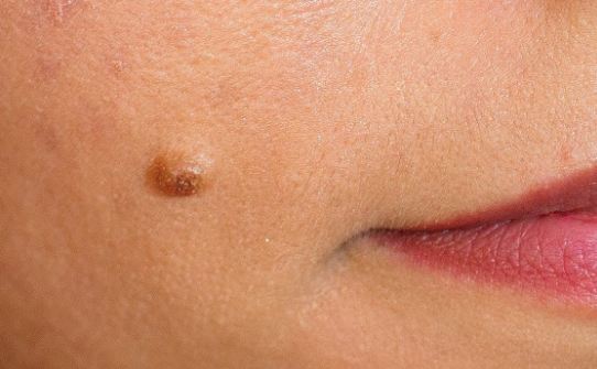 De ce papiloamele sunt periculoase Infectia cu HPV din perspectiva dermatologului
